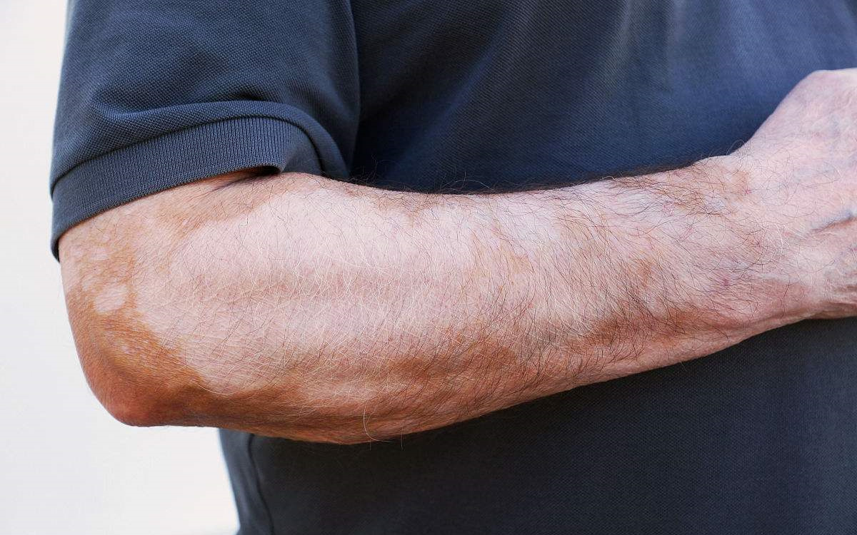 甲醛超標和白癜風有關系嗎？裝修污染對人體影響極大！